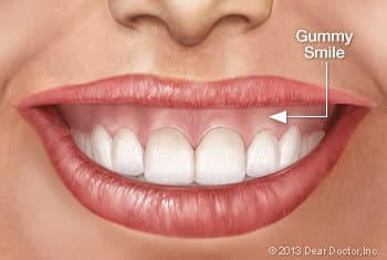 How to fix a gummy smile