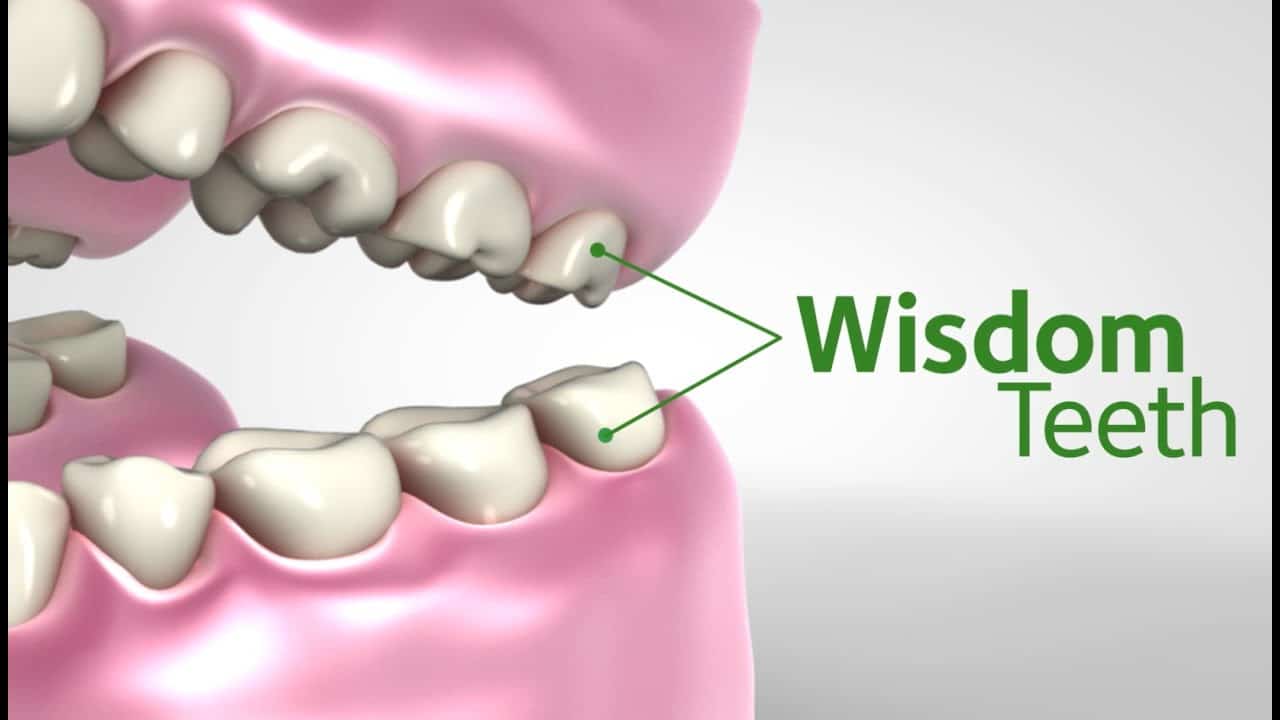 Wisdom tooth removal