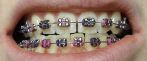 How Do Dentists Clean Teeth with Braces?