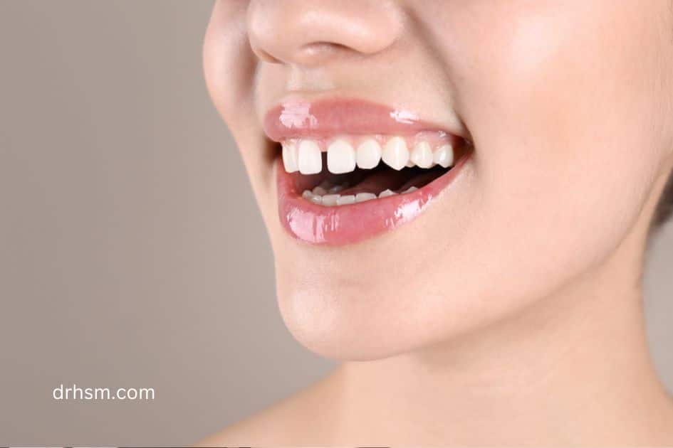 Closing Small Gaps in Teeth Comprehensive Solutions for a Perfect Smile 1