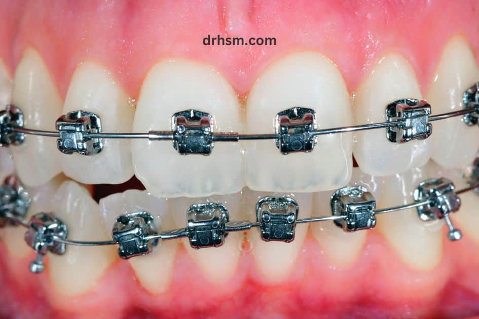 Closing Small Gaps in Teeth 