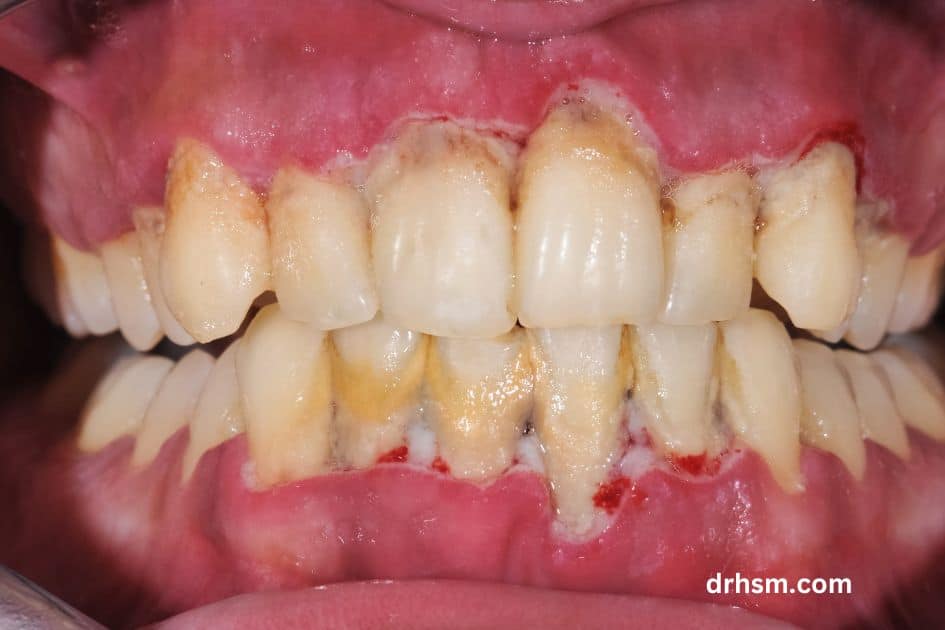 receding gum on one tooth