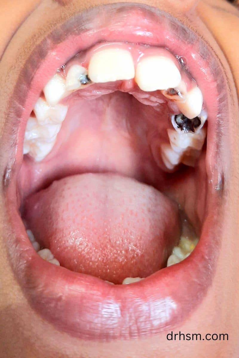 How to tell if you have cavity on front teeth?
