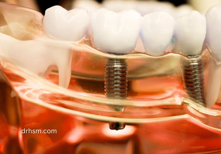 Dental Implant Supported Bridge