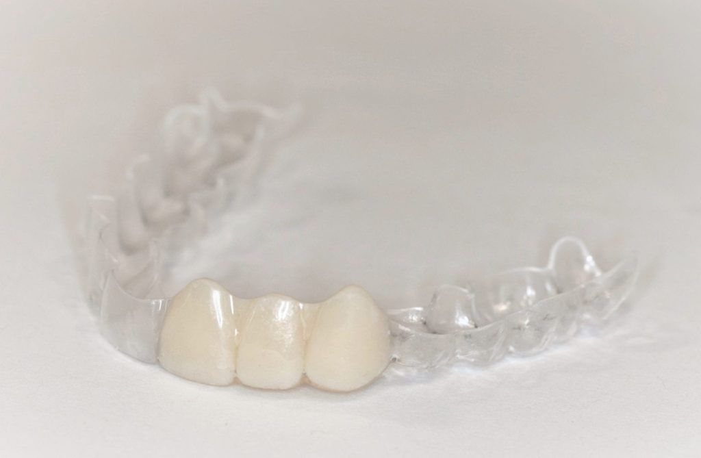 essix retainer