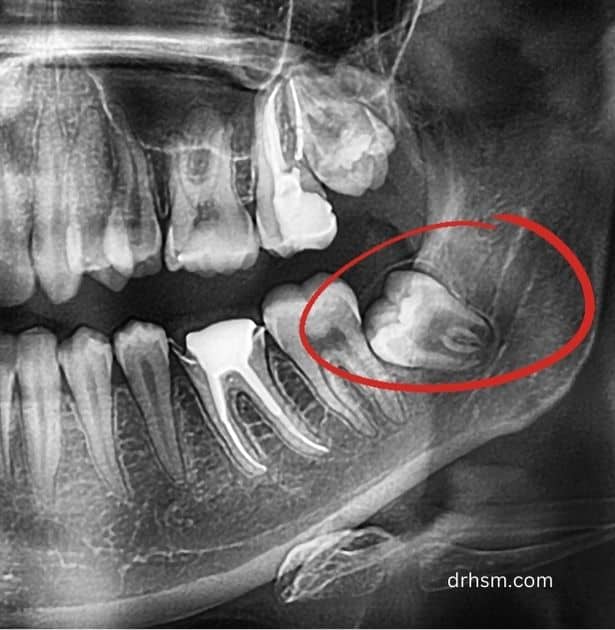 infected wisdom tooth 1