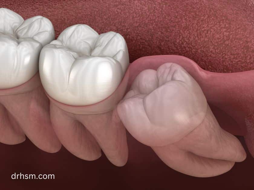 infected wisdom tooth